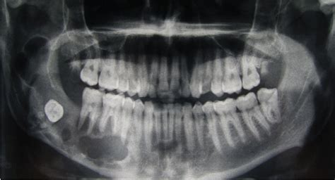 Figure 1 From Squamous Cell Carcinoma Arising From A Keratocystic