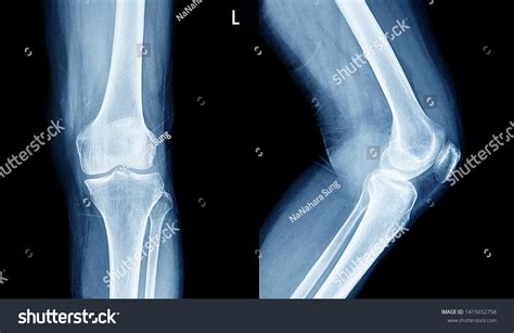 X Ray Osteoarthritis Images Stock Photos Vectors Shutterstock