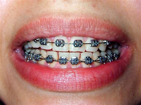 Appareil Dentaire Orthodontique Quel Appareil Dentaire Choisir