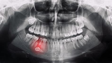 Ortopantomograf A Qu Es Y Para Qu Sirve Prodental