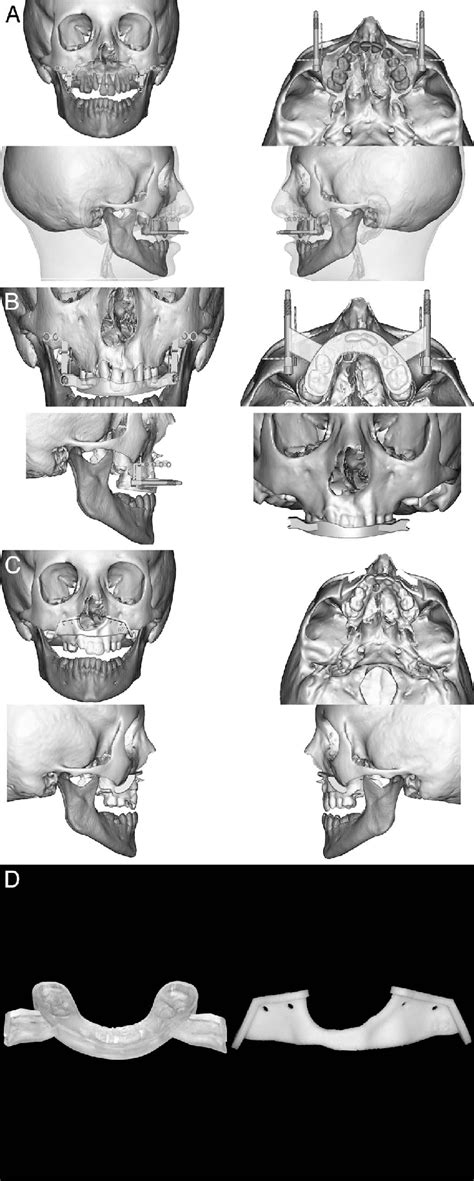 Preoperative Planning A Segmentation Of Three Dimensional Bone Download Scientific Diagram