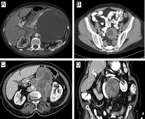 Computed Tomography Findings Of Three Retroperitoneal Ancient