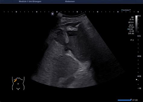 Gallbladder Perforation Atlas Of Ultrasound