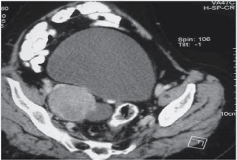 Cect Abdomen Showing Solid Cystic Lesion In Right Adnexa Measuring