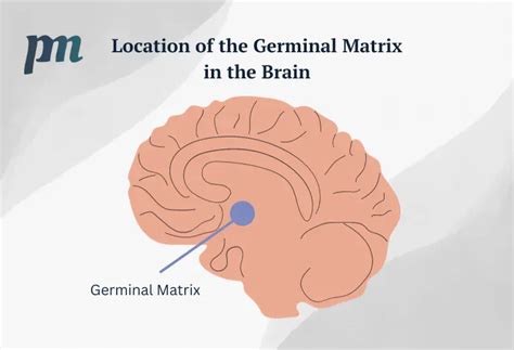 Explore Germinal Matrix Hemorrhage And Intraventricular Hemorrhage