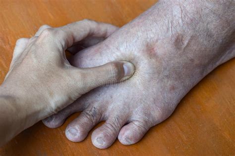 Pitting Edema Of Lower Limb Swollen Leg Of Asian Man Stock Image