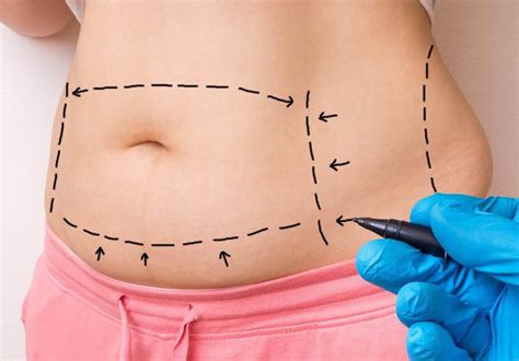 Abdominoplastia En Madrid Gu A Precio Resultados Antes Y Despues