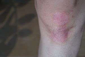 Treatments for Mild Psoriasis - Psoriasis Cure Now