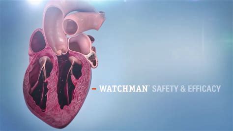 Watchman Implantation Technique Boston Scientific Youtube