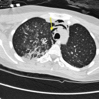 Chest CT scan. Arrow shows air in the mediastinum. | Download ...