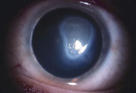 Vernal Ulcer American Academy Of Ophthalmology