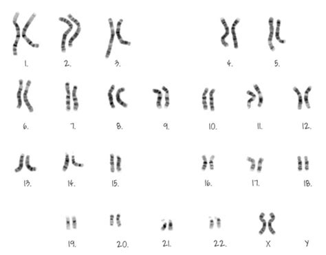 Topic 3 Genetics Chromosomes Karyotyping Analysis And Determining