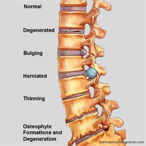 Bulging Disc Treatment At Home - All You Need Infos