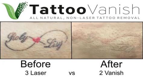 Tips To Get Prepared For Tattoo Removal Treatment Sessions