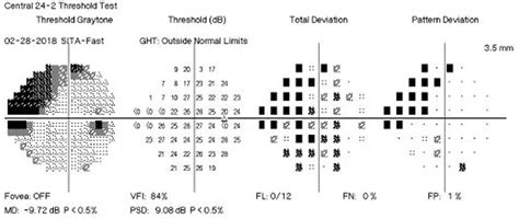 Most Glaucoma Patients Don’t Undergo Perimetry Annually