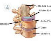 Qu Son La Lumbalgia Y La Ci Tica Top Doctors