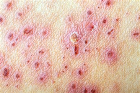 Shingles Vs Chickenpox Whats The Difference Healthier Steps