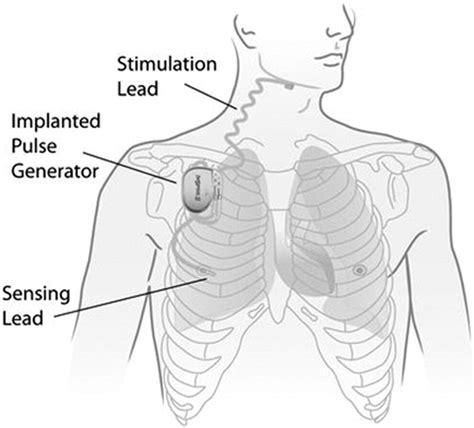 Operative Technique Of Upper Airway Stimulation An Implantable