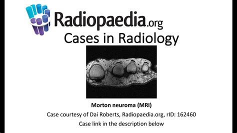 Morton Neuroma MRI Radiopaedia Org Cases In Radiology YouTube