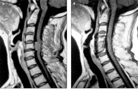 Contrast Enhanced Sagittal T1 Weighted Magnetic Resonance Imaging Scans