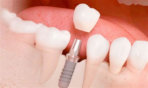 De qué está hecha la corona de un implante dental Implanet