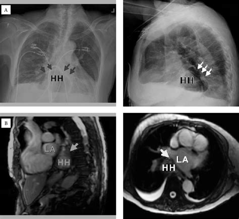 Figure 1 From Gastroesophageal Reflux Disease And Atrial Fibrillation Comorbidity Or Overlap