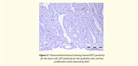 Figure 2 From Hidradenoma Papilliferum Of The Vulva Presenting As A