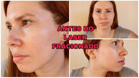 MEU ROSTO ANTES DO LASER FRACIONADO ERBIUM YouTube