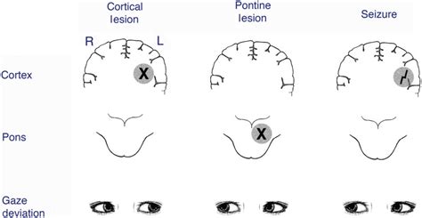 Eye Movement Disorders: Conjugate Gaze Abnormalities | Ento Key