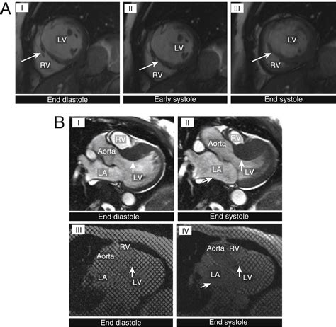 Abnormal Motion Patterns Of The Interventricular Septum JACC