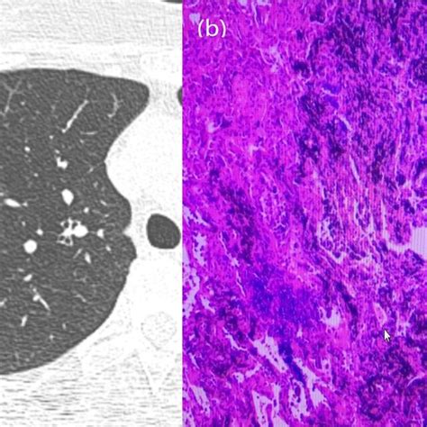 A 64 Year Old Woman With A Ggn Ct Showed Lobulation Pleural Traction Download Scientific