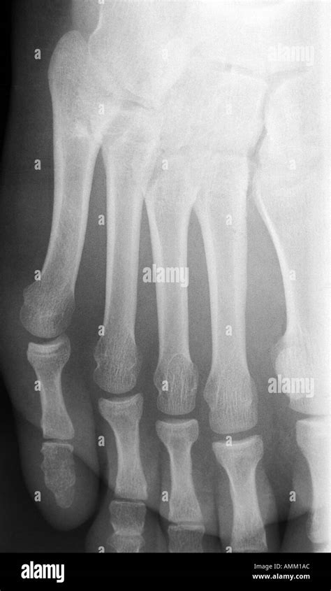 X Ray Transverse Fracture Of 5th Distal Phalanx Stock Photo Alamy