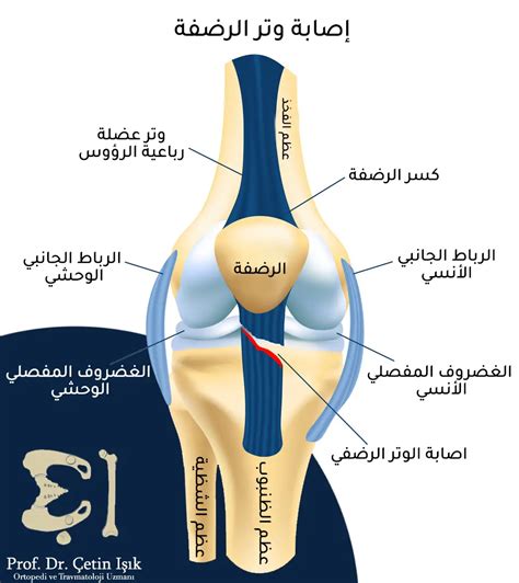 التهاب أوتار الركبة طرق علاجه بالمنزل د شتين اشيك