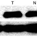 Protein Level Of Axl In Fresh Non Small Cell Lung Cancer Tissues And