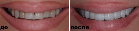 Люмініри на передні зуби • Ціна в Дніпрі ️ До і Після