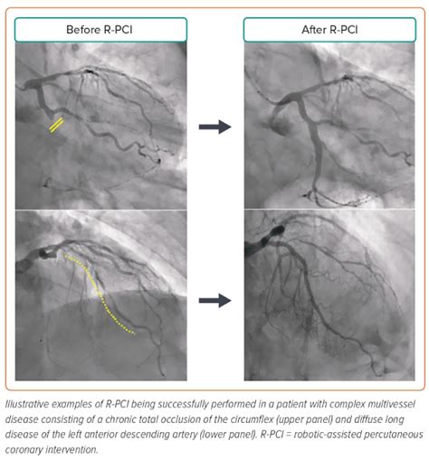 Figure 3 Case Examples Of Complex Robotic Assisted Percutaneous