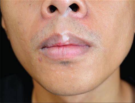 Lichen Planus Lips