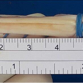 single bundle hamstring graft   anterior cruciate ligament