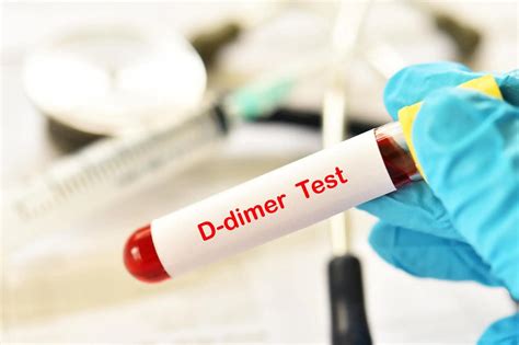 Understanding The Cost Of D Dimer Tests Health E