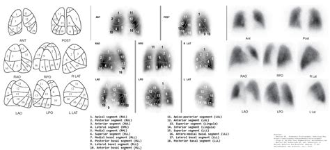 VQ Segments Poster | NucsRadiology.com