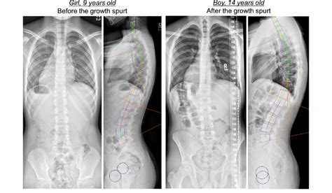 Posterior Anterior And Lateral Radiographs Of Two Subjects Showing The