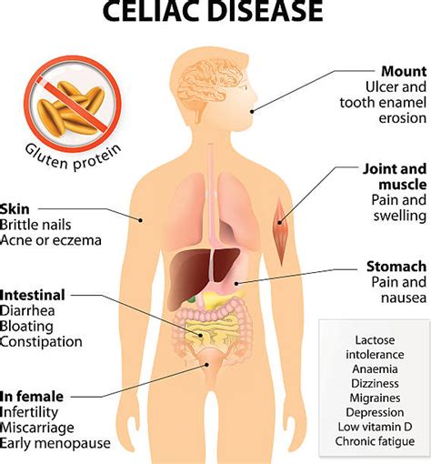 640 Celiac Disease Stock Illustrations Royalty Free Vector Graphics And Clip Art Istock