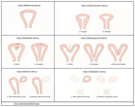 Eshre Esge Classification Of Uterine Anomalies Adapted From [6] Download Scientific Diagram