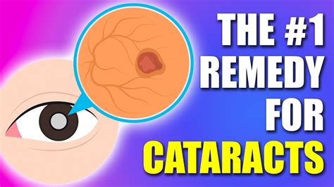 1 Remedy For Cataracts In 2024 Updated Youtube