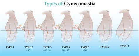 Gynecomastia Chiltern Medical Clinic