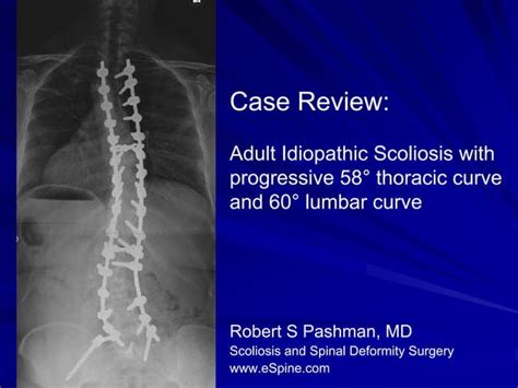 Case Review 13 50 Year Old Female With Progressive Adult Idiopathic