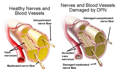 Diabetic Neuropathy Fight Diabetes