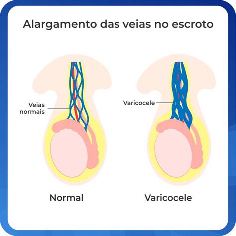 Cirurgia De Varicocele Contra Dores E Infertilidade Masculina Check