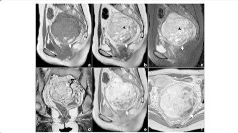 MRI examination of the pelvic cavity. Sagittal T1-weighted image (a)... | Download Scientific ...