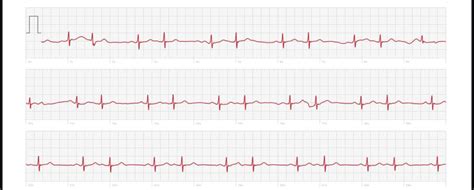 Is this bigeminy? : r/PVCs